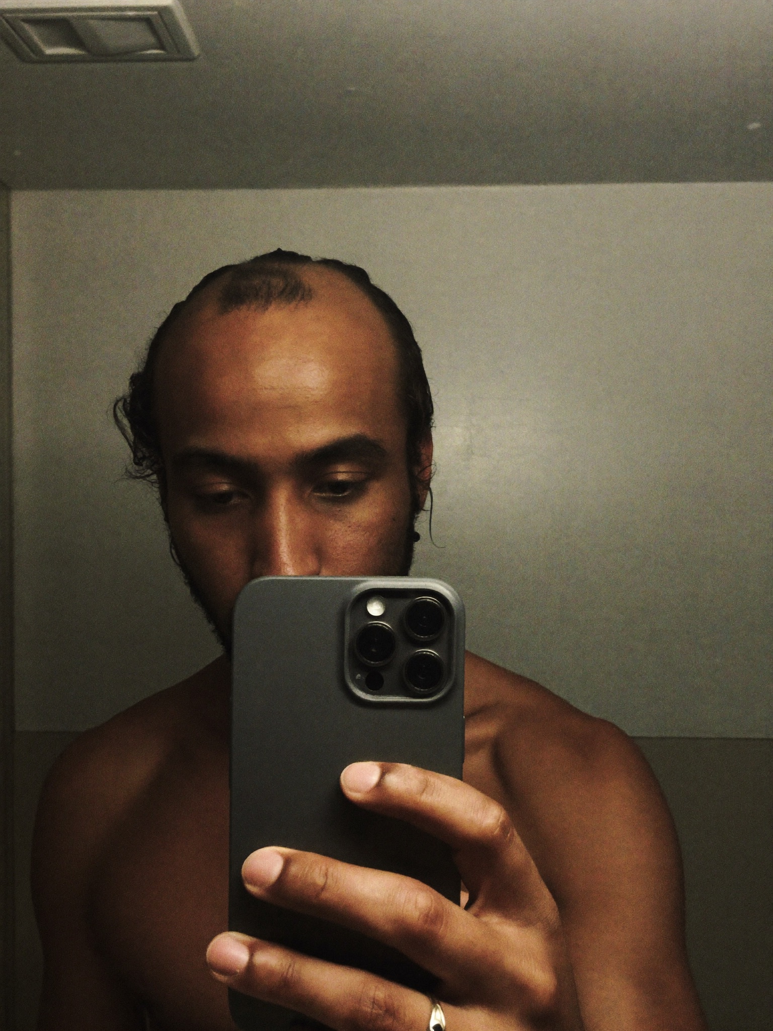 Bathroom mirror photo of a hairline — before treatment