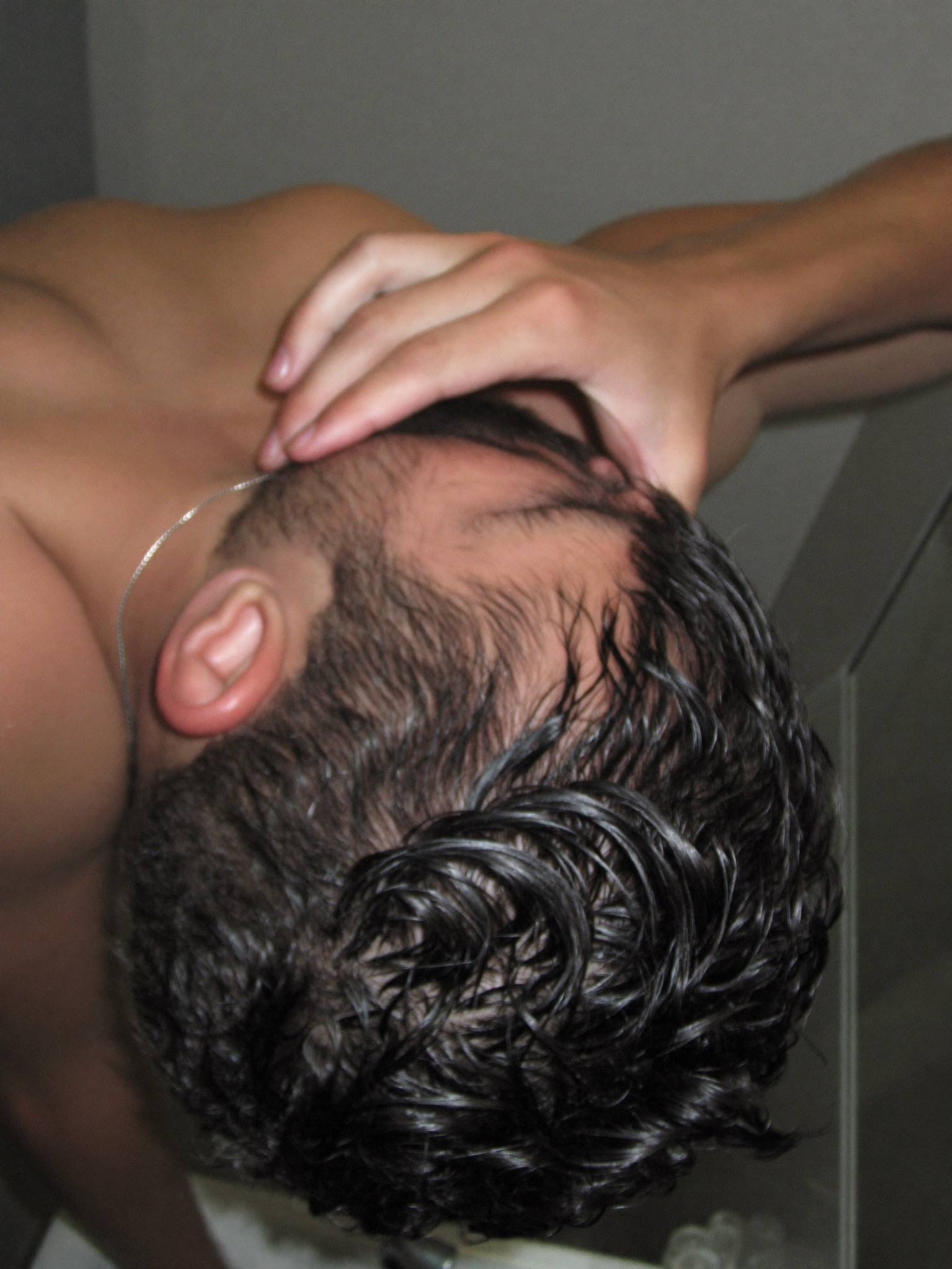 Close mirror inspection of the front hairline — before treatment